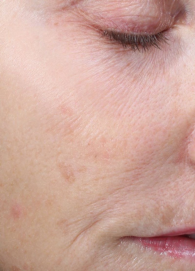 Halo Laser Before & After Gallery - Patient 133024088 - Image 3