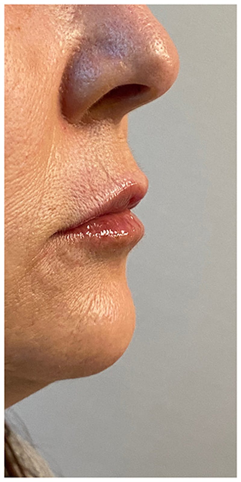 Dermal Fillers Before & After Gallery - Patient 133024098 - Image 6