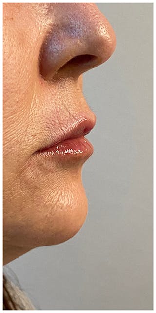 Dermal Fillers Before & After Gallery - Patient 133024098 - Image 6