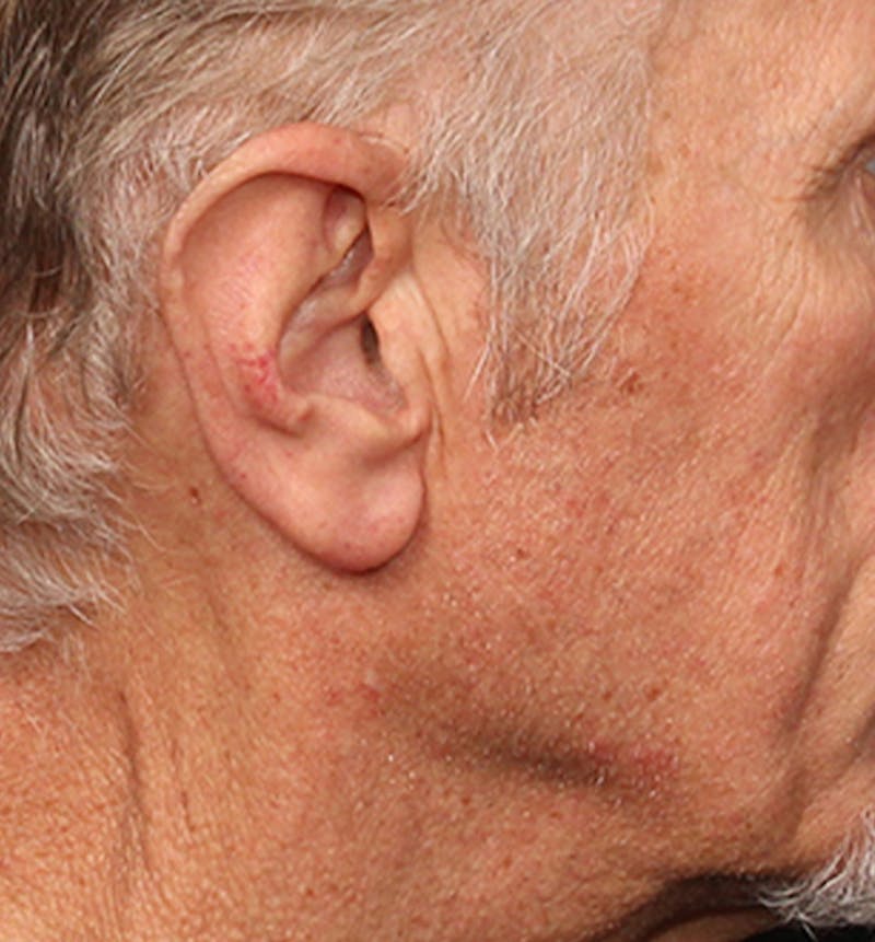 Facelift Scar Before & After Gallery - Patient 133024090 - Image 3