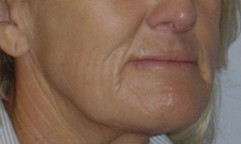 Laser Resurfacing Before & After Gallery - Patient 133024087 - Image 3
