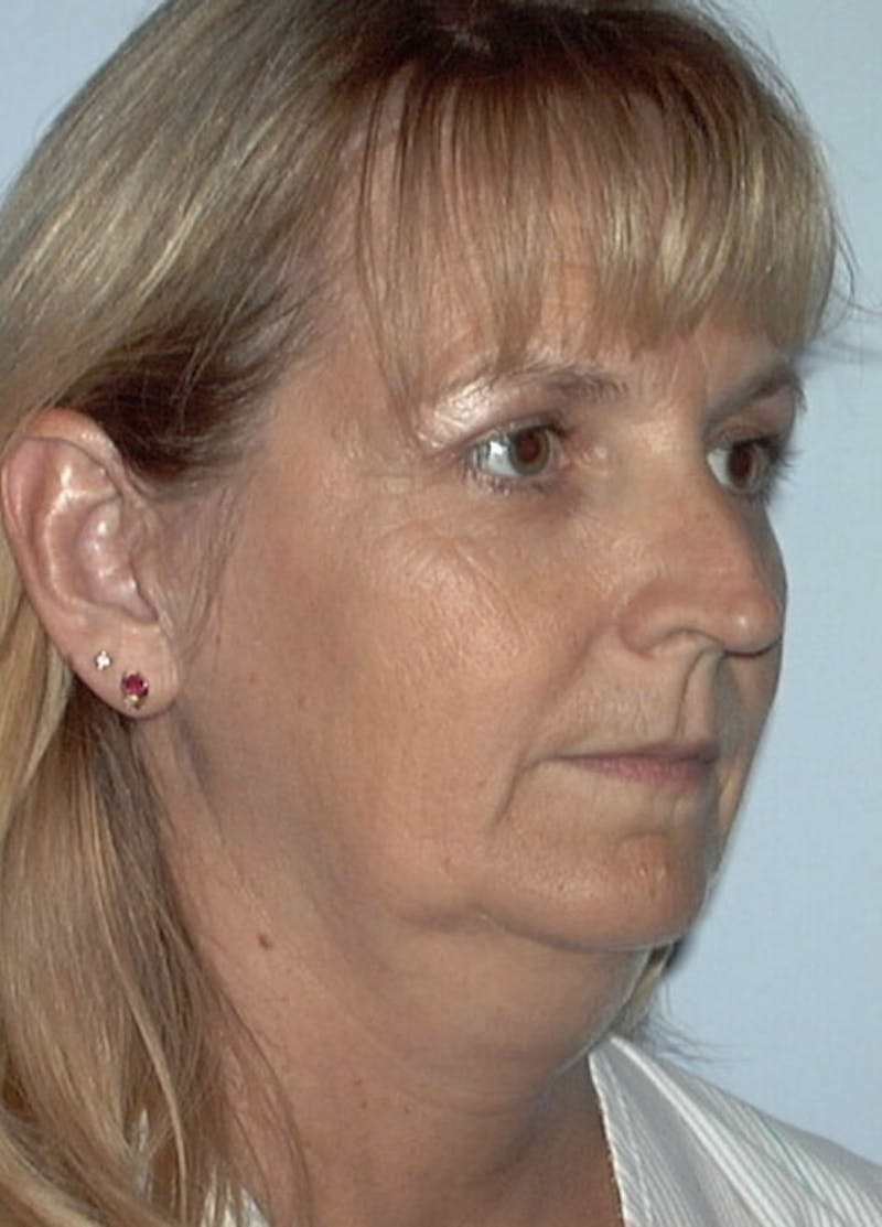 Facelift & Necklift Before & After Gallery - Patient 133024095 - Image 3