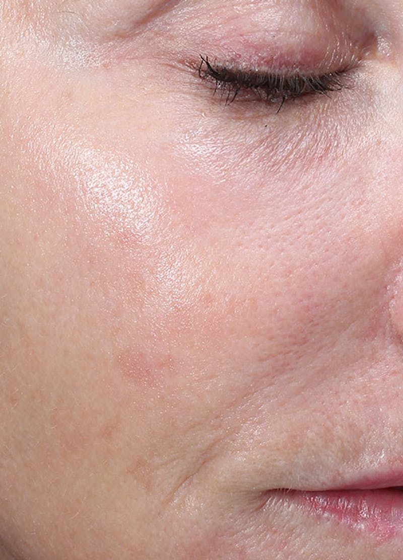 Halo Laser Before & After Gallery - Patient 133024088 - Image 4