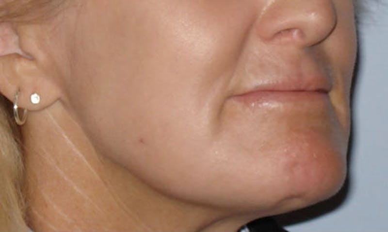 Laser Resurfacing Before & After Gallery - Patient 133024087 - Image 4