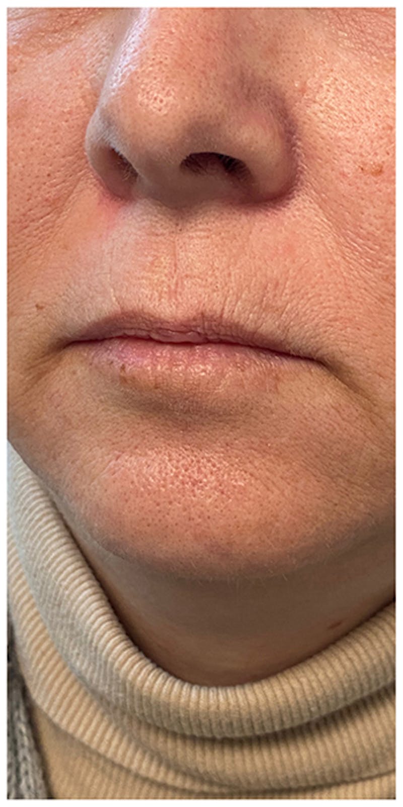 Dermal Fillers Before & After Gallery - Patient 133024098 - Image 7