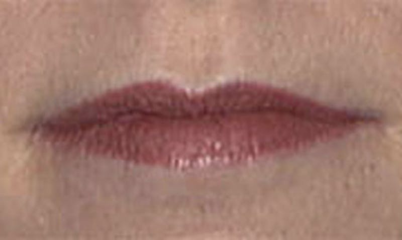 Lip Enhancement Before & After Gallery - Patient 133024091 - Image 1