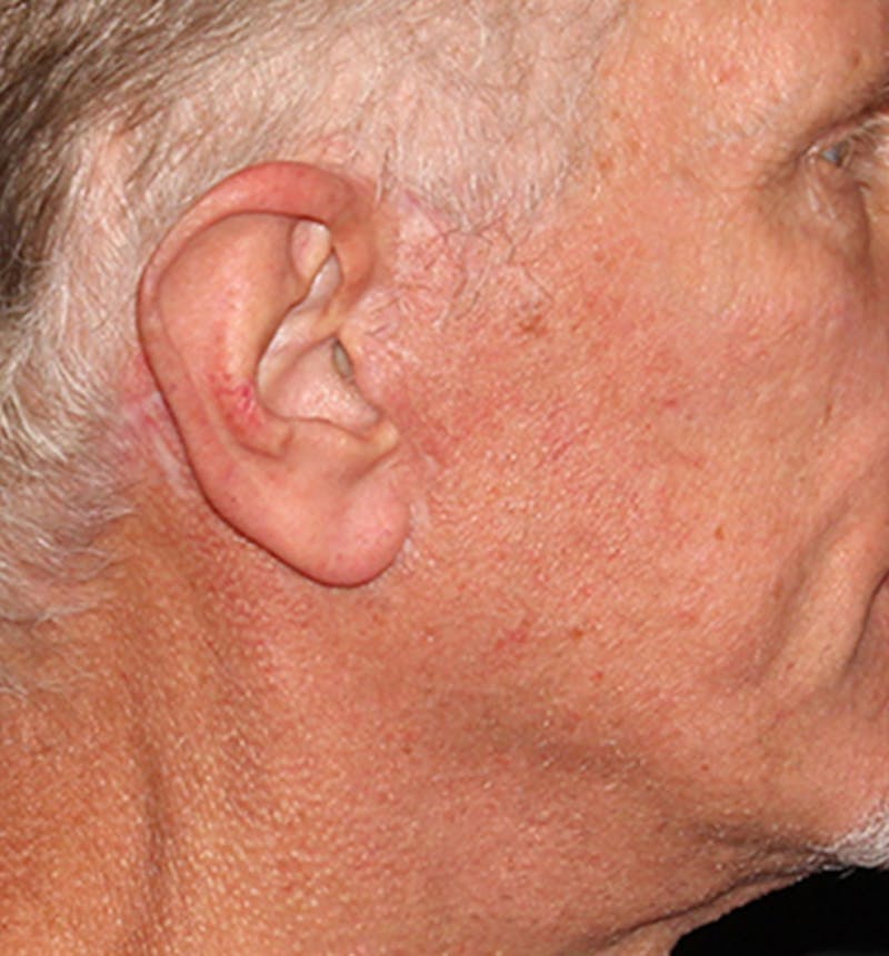 Facelift Scar Before & After Gallery - Patient 133024090 - Image 4