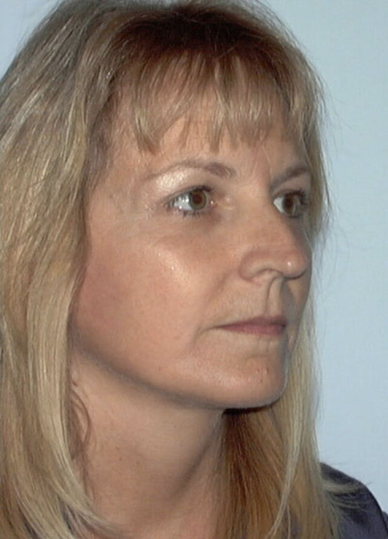 Facelift & Necklift Before & After Gallery - Patient 133024095 - Image 4
