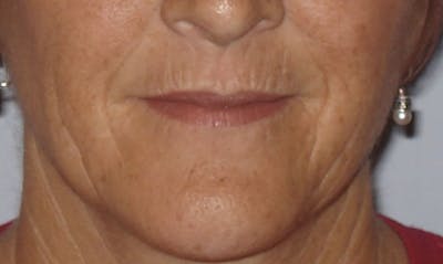Laser Resurfacing Before & After Gallery - Patient 133024097 - Image 1
