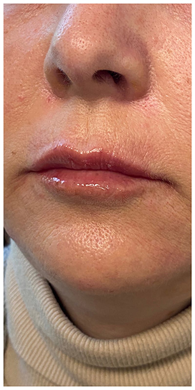 Dermal Fillers Before & After Gallery - Patient 133024098 - Image 8