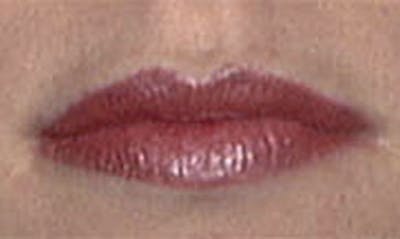 Lip Enhancement Before & After Gallery - Patient 133024091 - Image 2