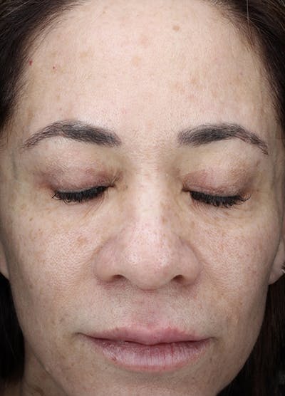 Halo Laser Before & After Gallery - Patient 133024107 - Image 1