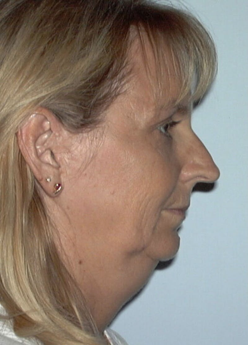 Facelift & Necklift Before & After Gallery - Patient 133024095 - Image 5