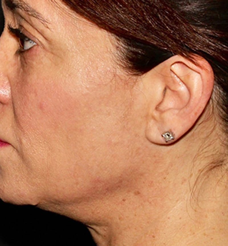 Facelift Scar Before & After Gallery - Patient 133024100 - Image 1