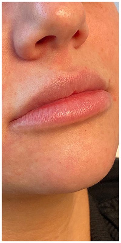 Lip Enhancement Before & After Gallery - Patient 133024094 - Image 1