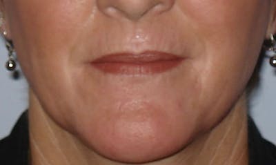 Laser Resurfacing Before & After Gallery - Patient 133024097 - Image 2