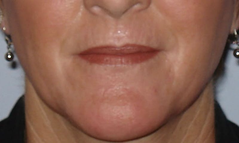 Laser Resurfacing Before & After Gallery - Patient 133024097 - Image 2