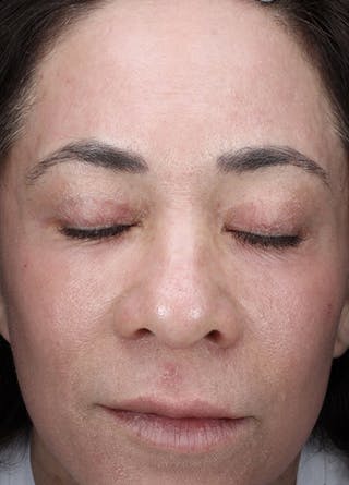 Halo Laser Before & After Gallery - Patient 133024107 - Image 2