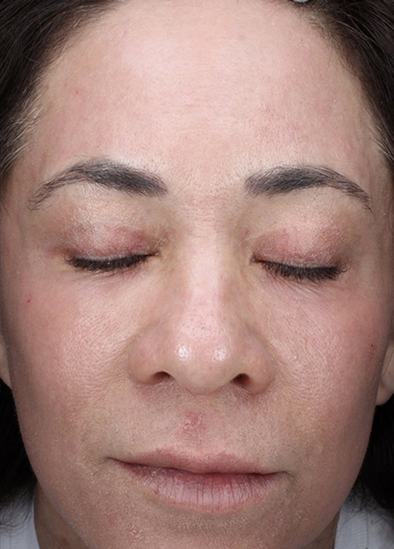 Halo Laser Before & After Gallery - Patient 133024107 - Image 2