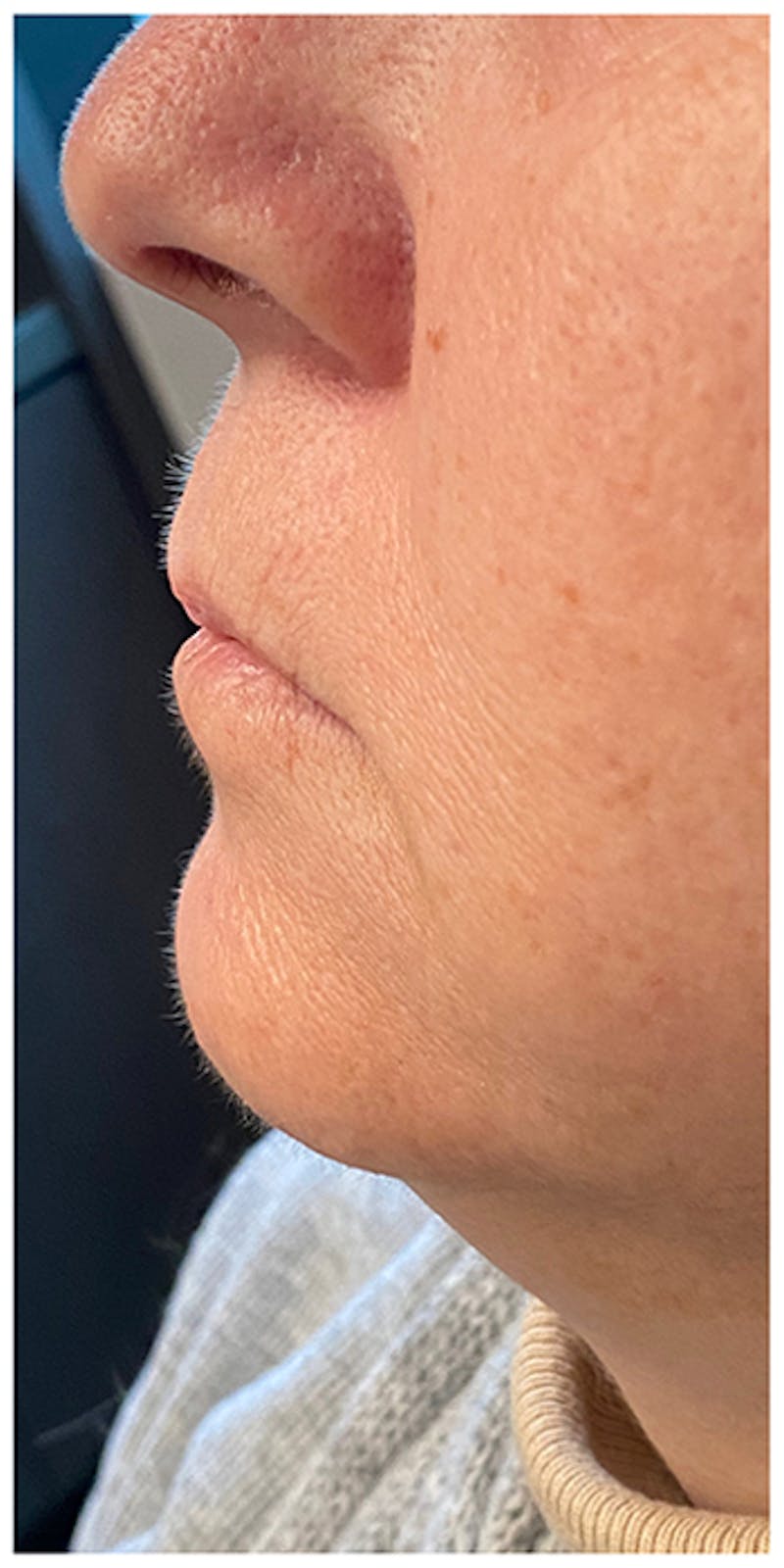 Dermal Fillers Before & After Gallery - Patient 133024098 - Image 9