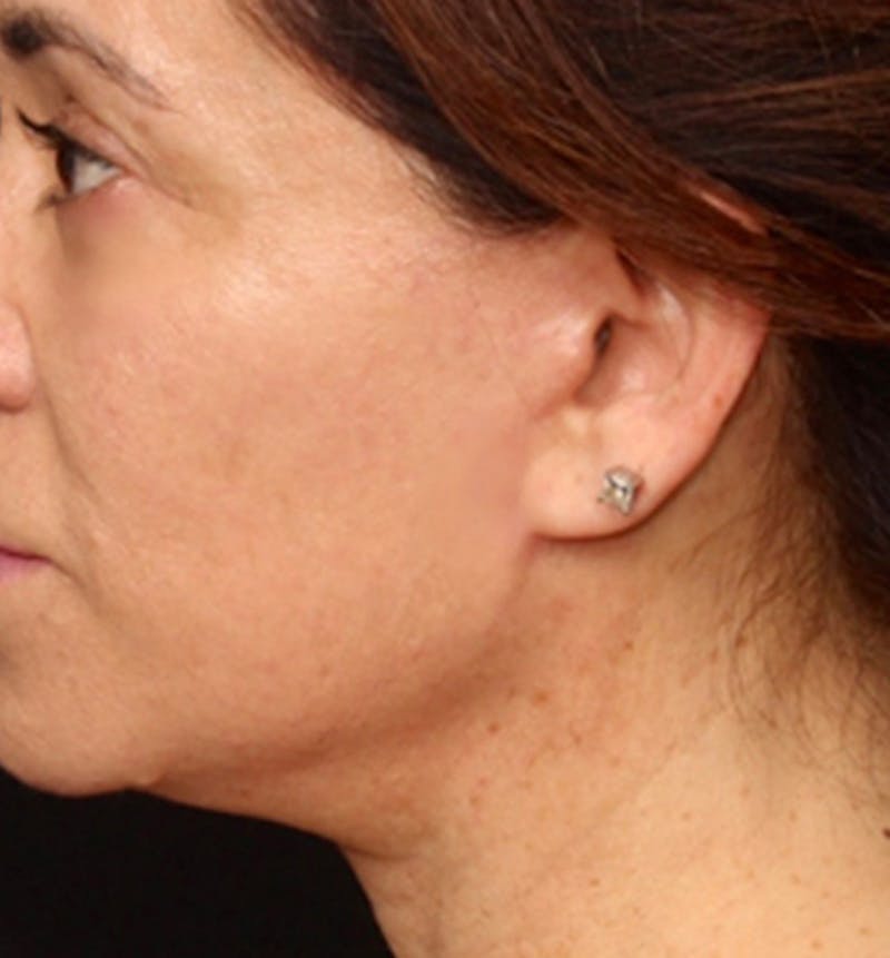 Facelift Scar Before & After Gallery - Patient 133024100 - Image 2