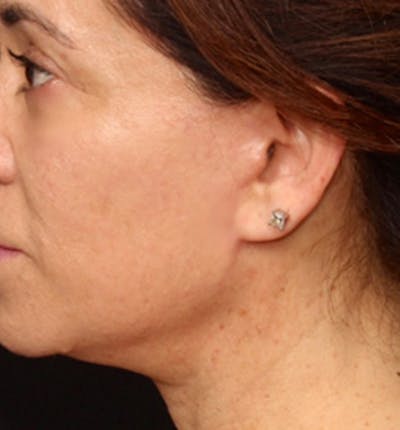 Facelift Scar Before & After Gallery - Patient 133024100 - Image 2