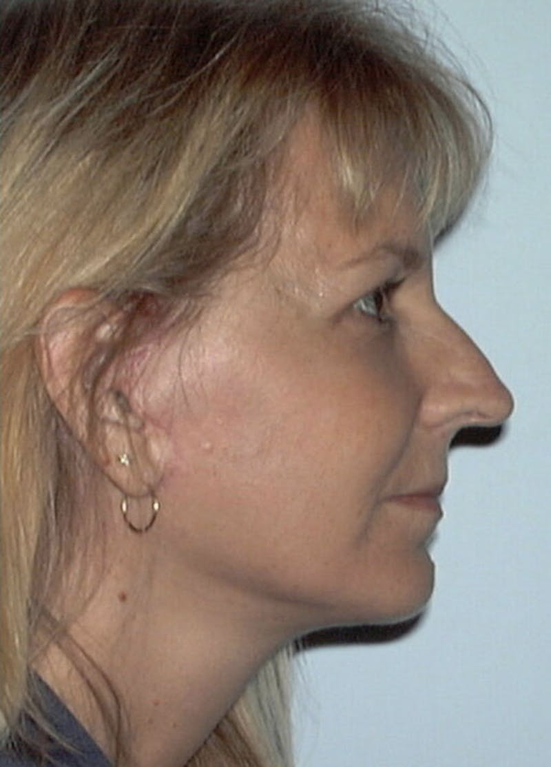 Facelift & Necklift Before & After Gallery - Patient 133024095 - Image 6