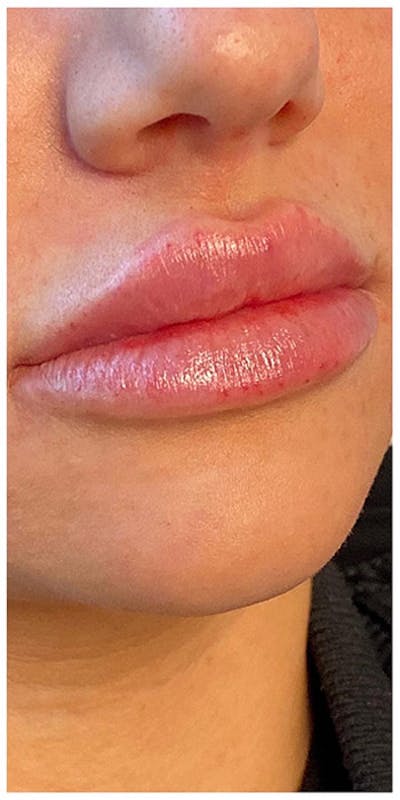 Lip Enhancement Before & After Gallery - Patient 133024094 - Image 2