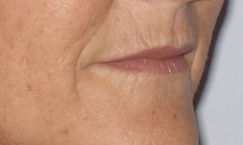 Laser Resurfacing Before & After Gallery - Patient 133024097 - Image 3