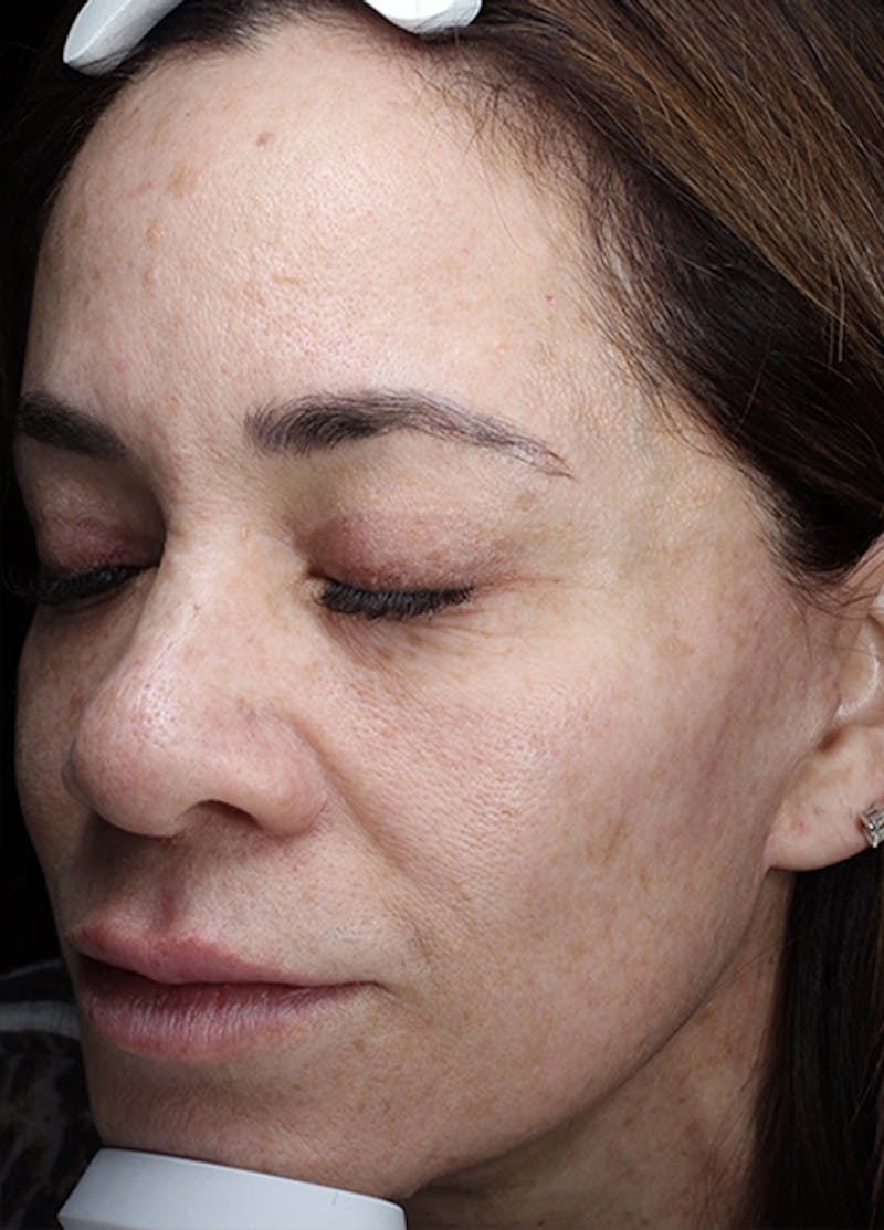 Halo Laser Before & After Gallery - Patient 133024107 - Image 3