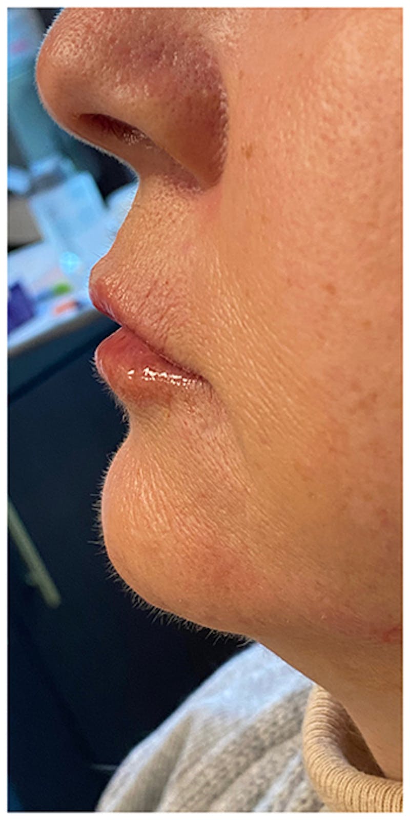 Dermal Fillers Before & After Gallery - Patient 133024098 - Image 10