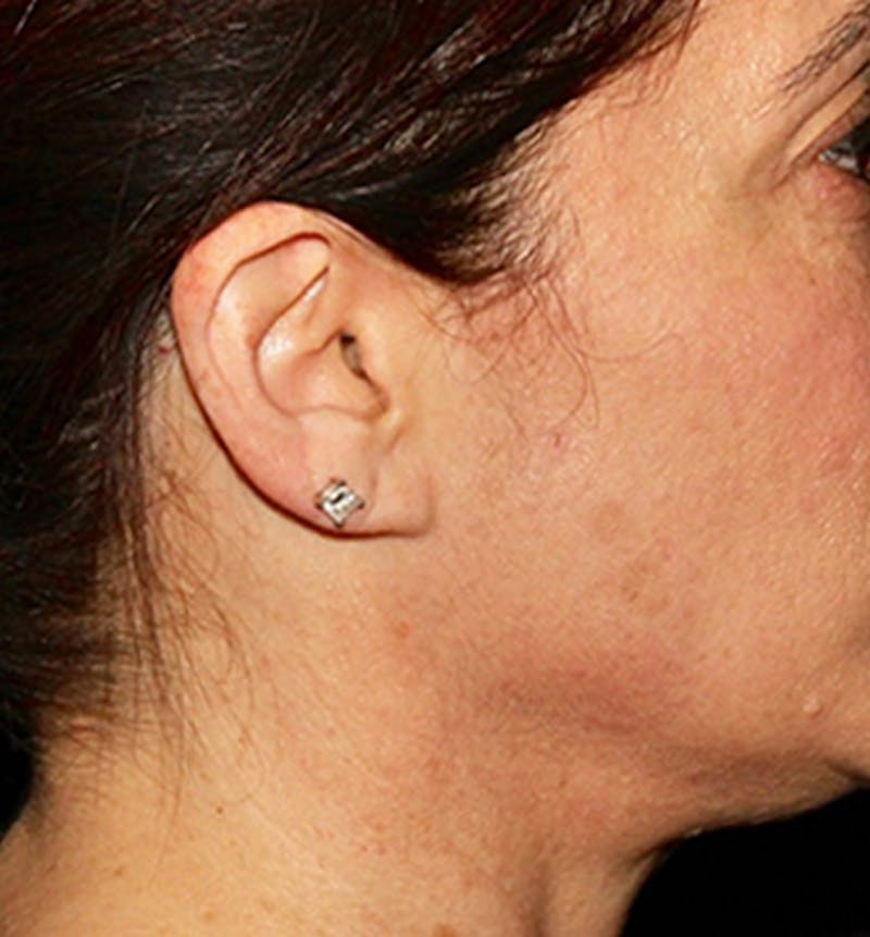 Facelift Scar Before & After Gallery - Patient 133024100 - Image 3