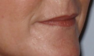 Laser Resurfacing Before & After Gallery - Patient 133024097 - Image 4