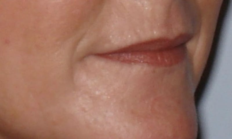 Laser Resurfacing Before & After Gallery - Patient 133024097 - Image 4