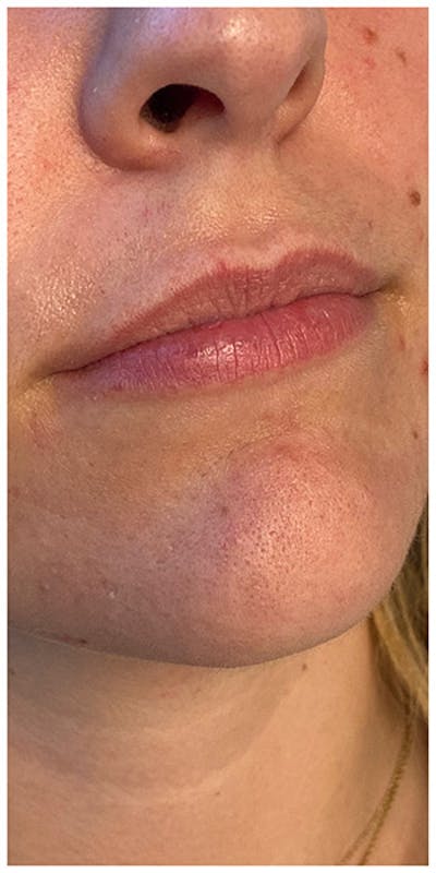 Lip Enhancement Before & After Gallery - Patient 133024101 - Image 1