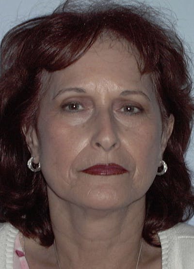 Facelift & Necklift Before & After Gallery - Patient 133024106 - Image 1