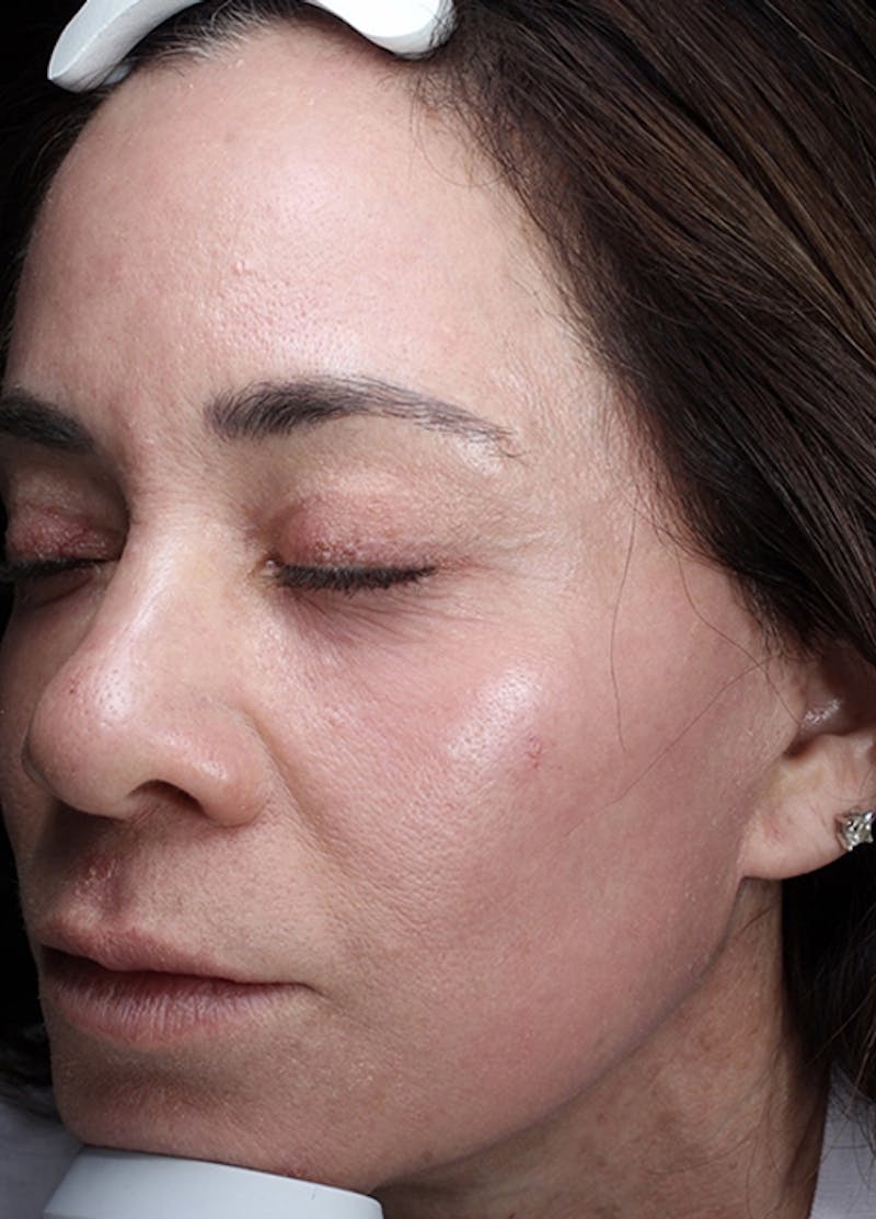 Halo Laser Before & After Gallery - Patient 133024107 - Image 4
