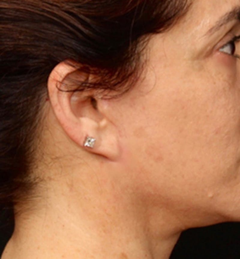 Facelift Scar Before & After Gallery - Patient 133024100 - Image 4