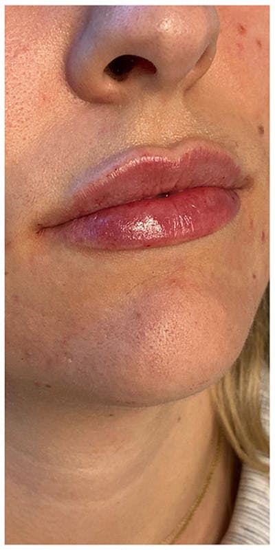 Lip Enhancement Before & After Gallery - Patient 133024101 - Image 2