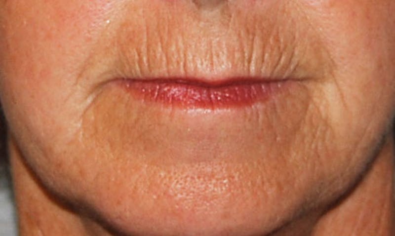 Laser Resurfacing Before & After Gallery - Patient 133024102 - Image 1