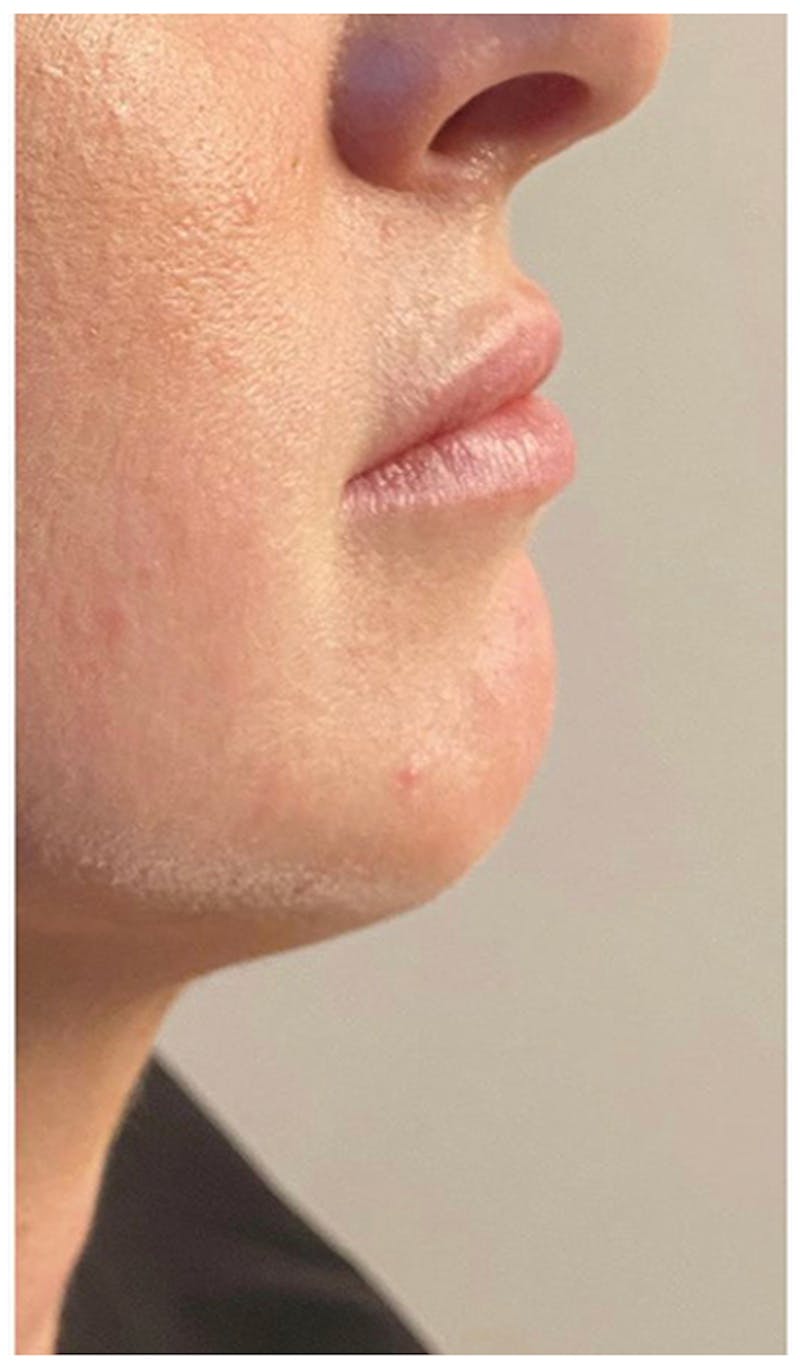 Dermal Fillers Before & After Gallery - Patient 133024104 - Image 1
