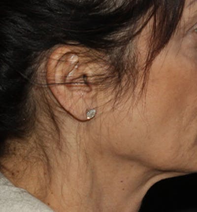 Facelift Scar Before & After Gallery - Patient 133024111 - Image 1