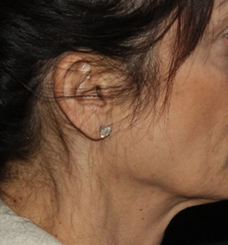 Facelift Scar Before & After Gallery - Patient 133024111 - Image 1