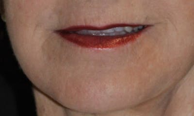 Laser Resurfacing Before & After Gallery - Patient 133024102 - Image 2