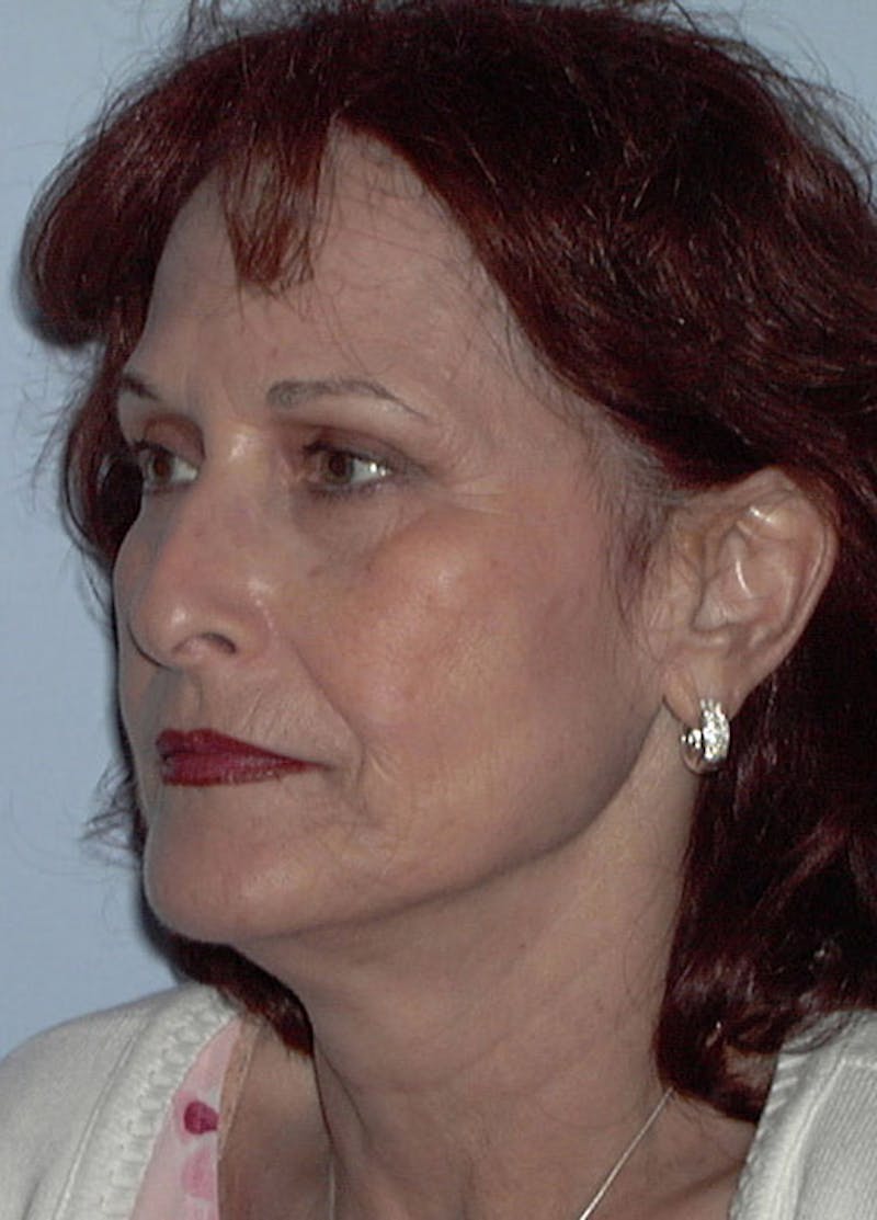 Facelift & Necklift Before & After Gallery - Patient 133024106 - Image 3