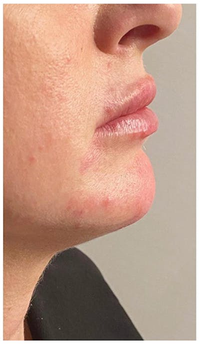 Dermal Fillers Before & After Gallery - Patient 133024104 - Image 2