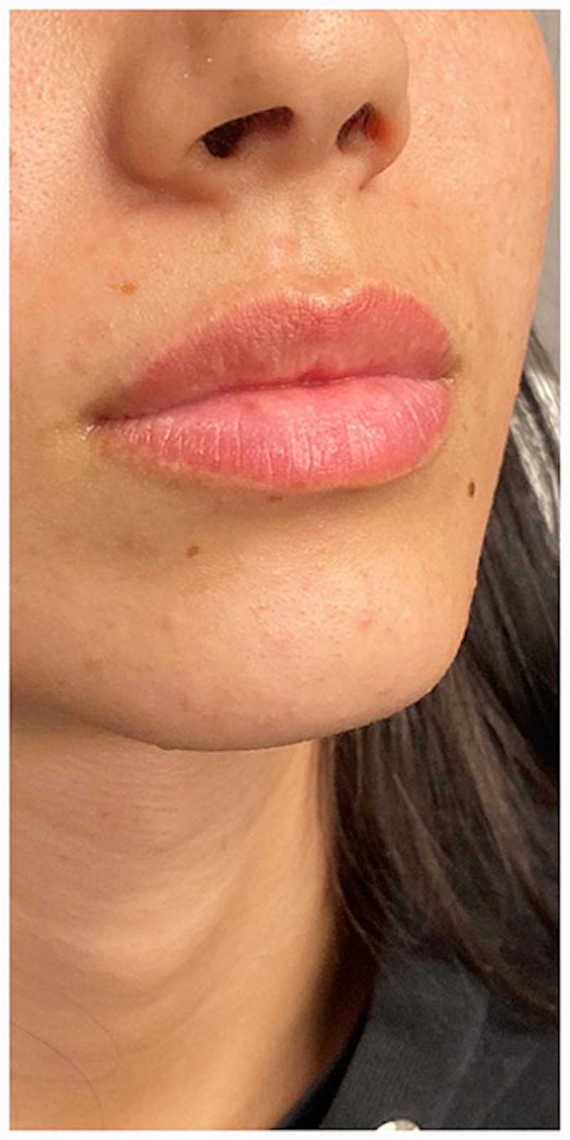 Lip Enhancement Before & After Gallery - Patient 133024105 - Image 1