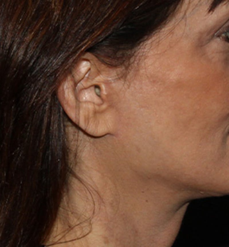 Facelift Scar Before & After Gallery - Patient 133024111 - Image 2