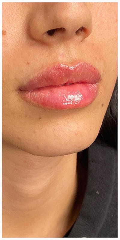 Lip Enhancement Before & After Gallery - Patient 133024105 - Image 2