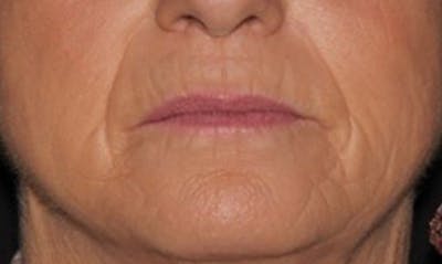 Laser Resurfacing Before & After Gallery - Patient 133024112 - Image 1